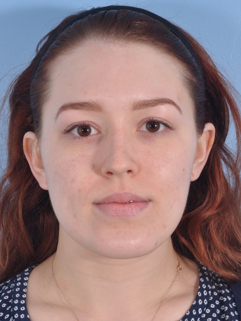 Rhinoplasty Before & After Gallery - Patient 295083 - Image 3