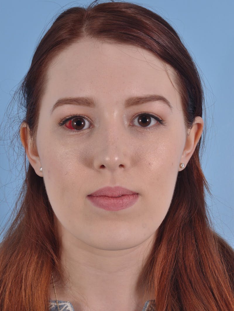 Rhinoplasty Before & After Gallery - Patient 295083 - Image 4