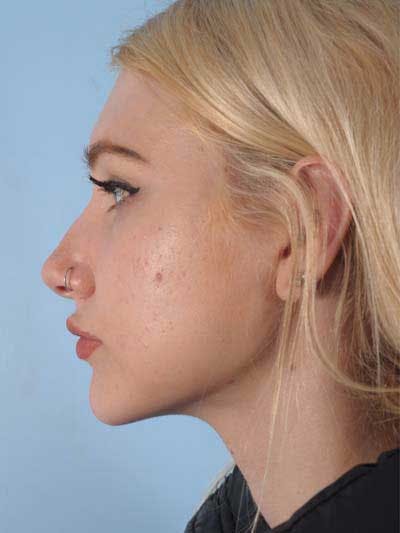 Rhinoplasty Before & After Gallery - Patient 410336 - Image 1