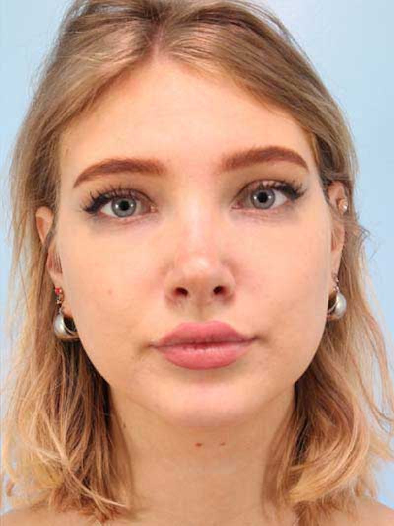 Rhinoplasty Before & After Gallery - Patient 410336 - Image 4