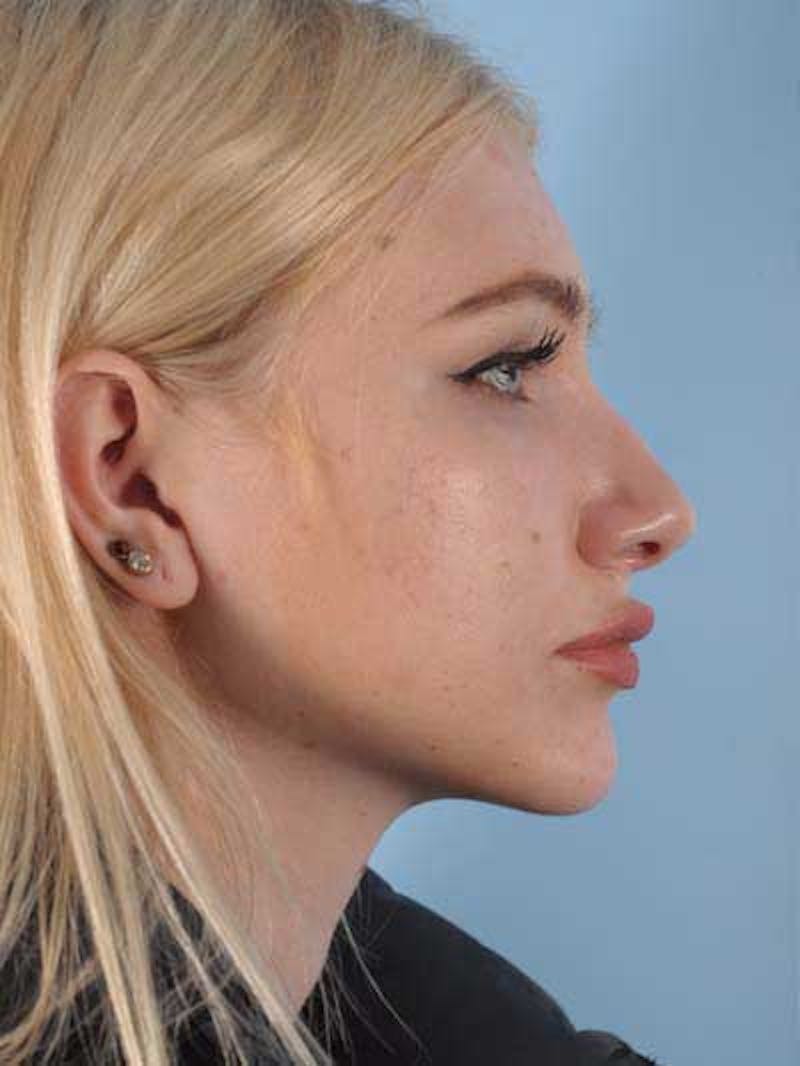 Rhinoplasty Before & After Gallery - Patient 410336 - Image 5