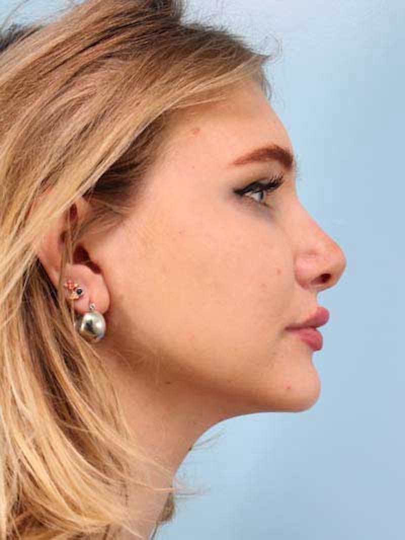 Rhinoplasty Before & After Gallery - Patient 410336 - Image 6