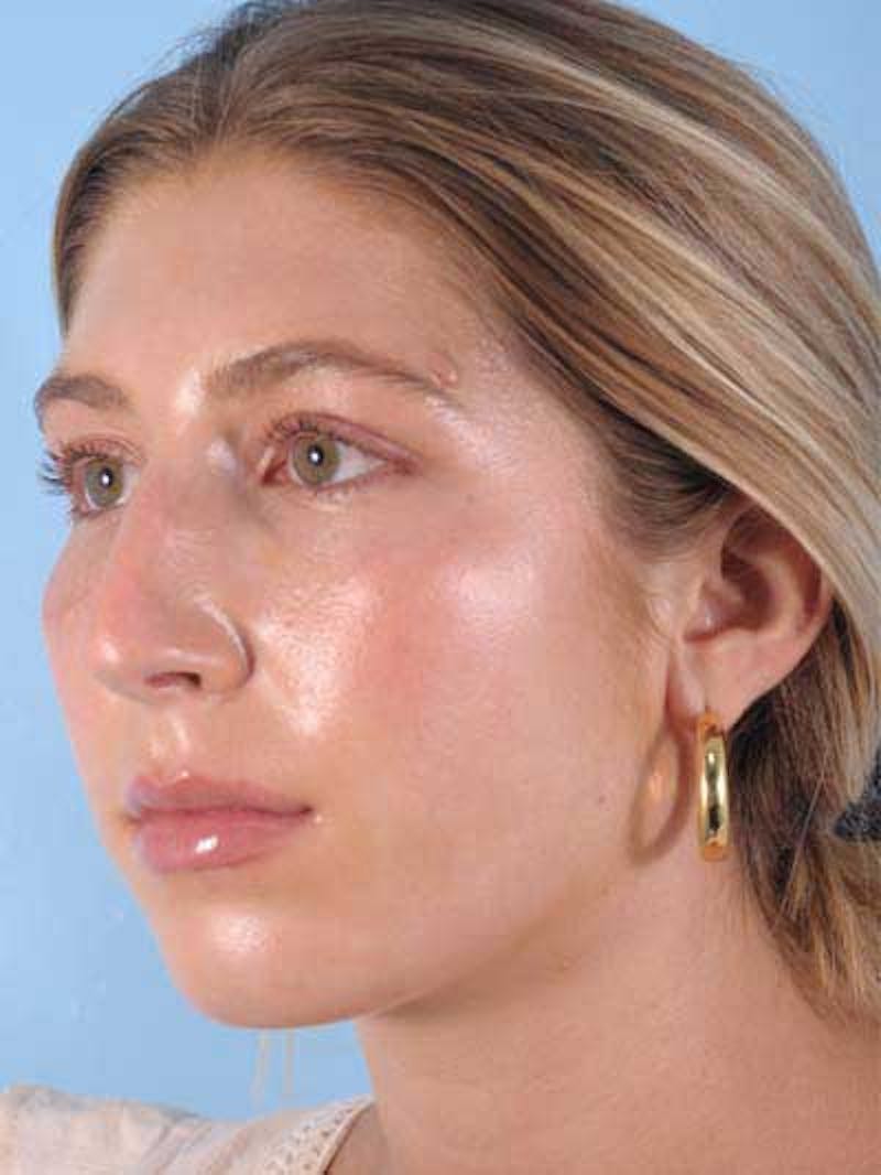 Rhinoplasty Before & After Gallery - Patient 764396 - Image 7