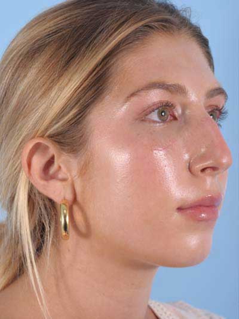 Rhinoplasty Before & After Gallery - Patient 764396 - Image 9