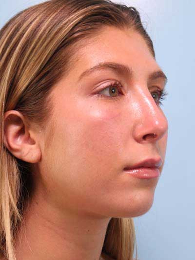 Rhinoplasty Before & After Gallery - Patient 764396 - Image 10