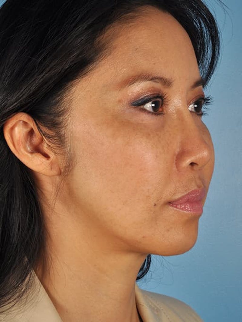 Silhouette Lift Before & After Gallery - Patient 405680 - Image 3