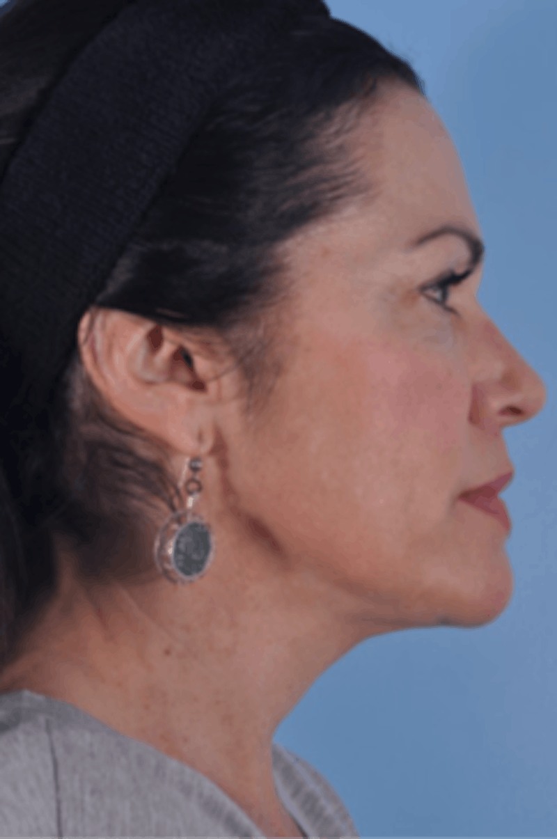 Brow Lift Before & After Gallery - Patient 226047 - Image 3