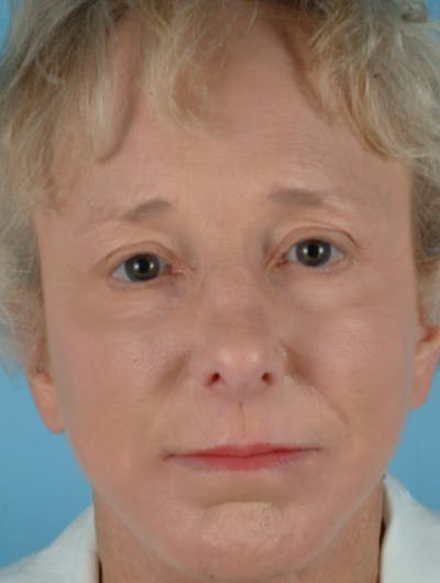 Brow Lift Before & After Gallery - Patient 338188 - Image 2