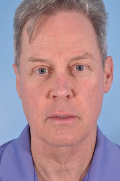 Brow Lift Before & After Gallery - Patient 134668 - Image 1