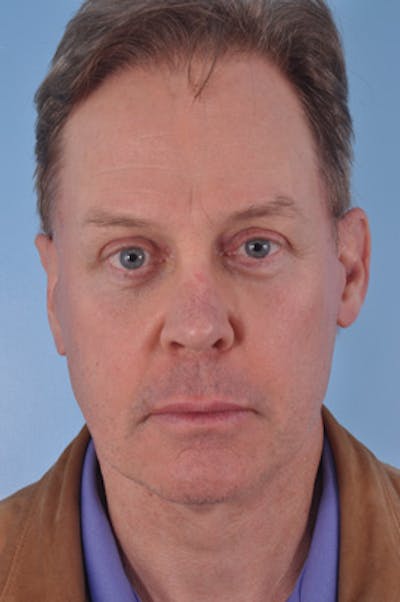 Brow Lift Before & After Gallery - Patient 134668 - Image 2