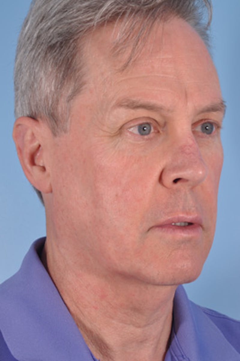 Brow Lift Before & After Gallery - Patient 134668 - Image 3