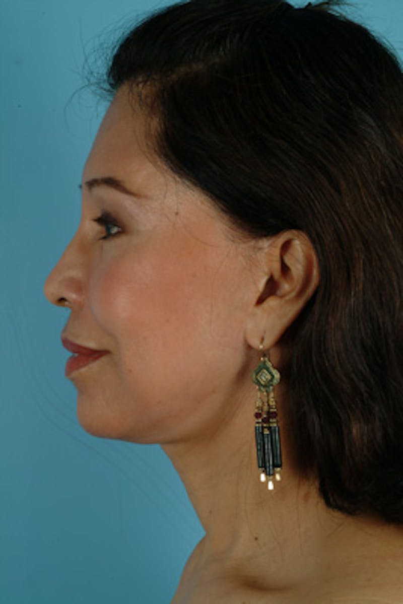 Brow Lift Before & After Gallery - Patient 406690 - Image 4