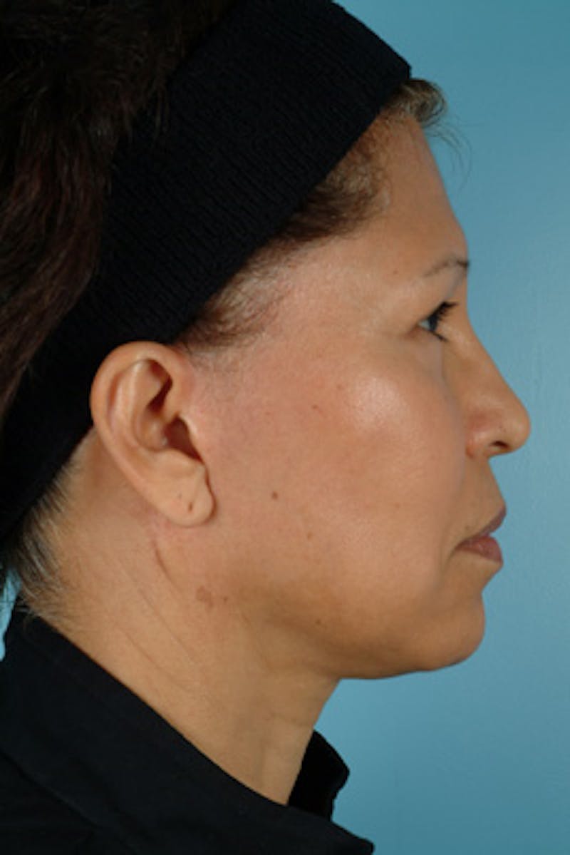 Brow Lift Before & After Gallery - Patient 406690 - Image 5
