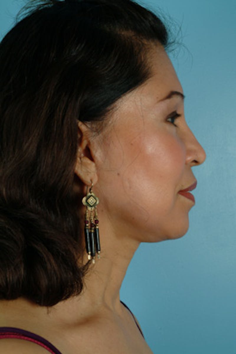 Brow Lift Before & After Gallery - Patient 406690 - Image 6