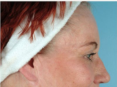 Brow Lift Before & After Gallery - Patient 971928 - Image 1