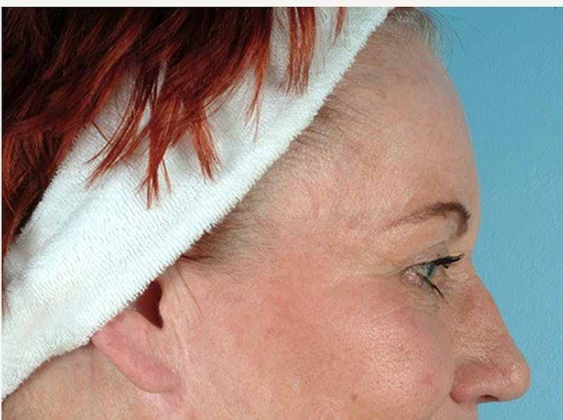 Brow Lift Before & After Gallery - Patient 971928 - Image 1