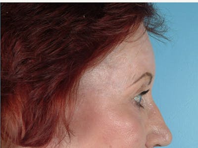 Brow Lift Before & After Gallery - Patient 971928 - Image 2