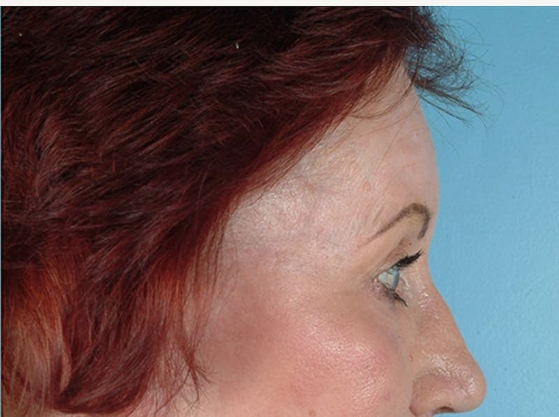 Brow Lift Before & After Gallery - Patient 971928 - Image 2