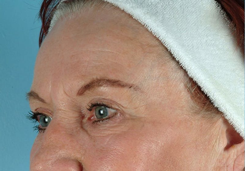 Brow Lift Before & After Gallery - Patient 971928 - Image 3