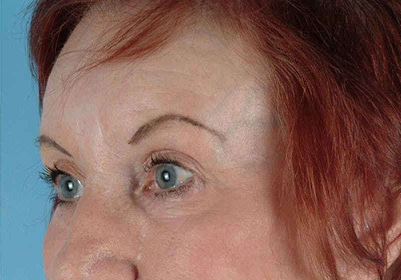 Brow Lift Before & After Gallery - Patient 971928 - Image 4