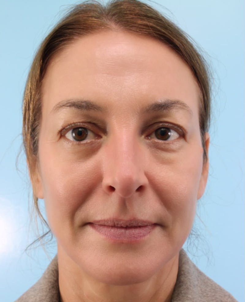 Lower Blepharoplasty Before & After Gallery - Patient 242425 - Image 1