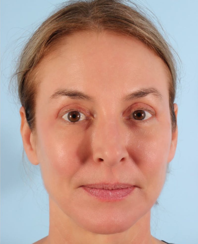 Lower Blepharoplasty Before & After Gallery - Patient 242425 - Image 2