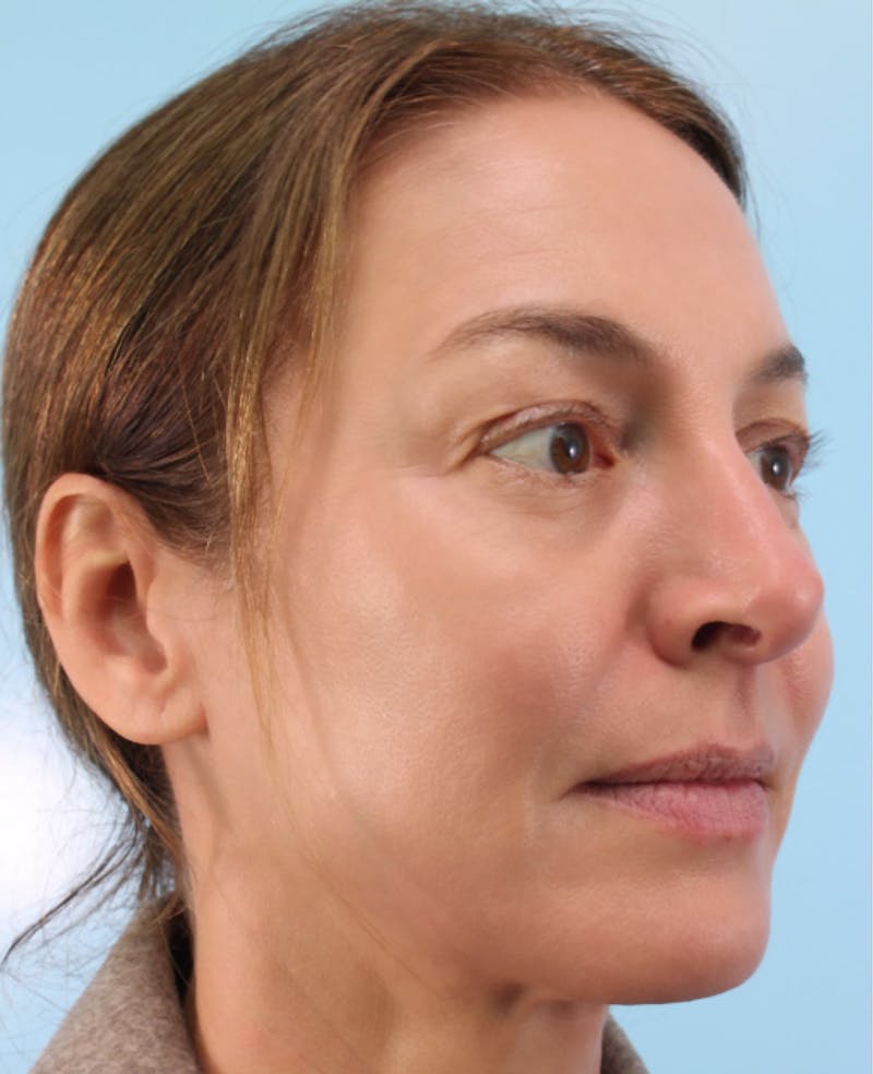 Lower Blepharoplasty Before & After Gallery - Patient 242425 - Image 3