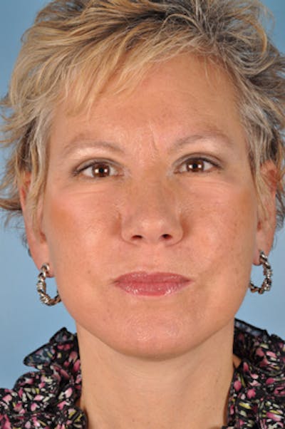 Upper Blepharoplasty Before & After Gallery - Patient 778642 - Image 2