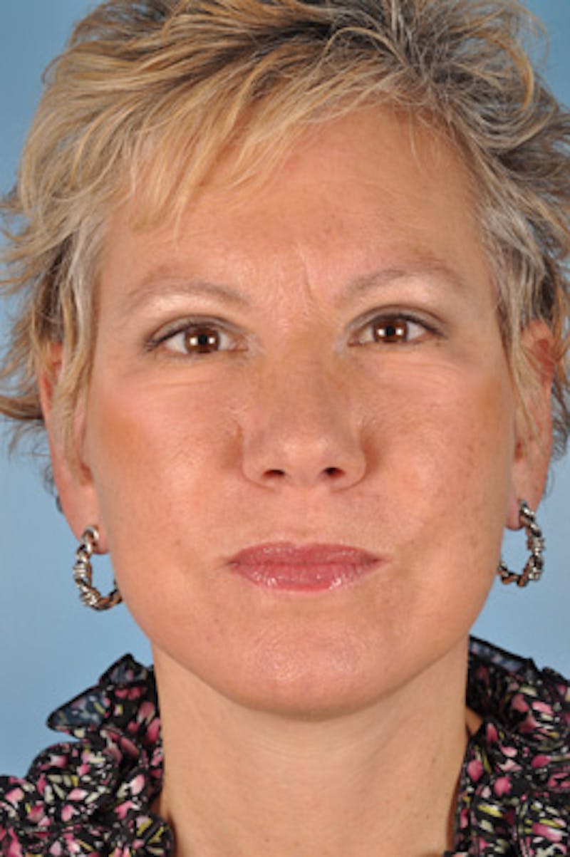 Upper Blepharoplasty Before & After Gallery - Patient 778642 - Image 2