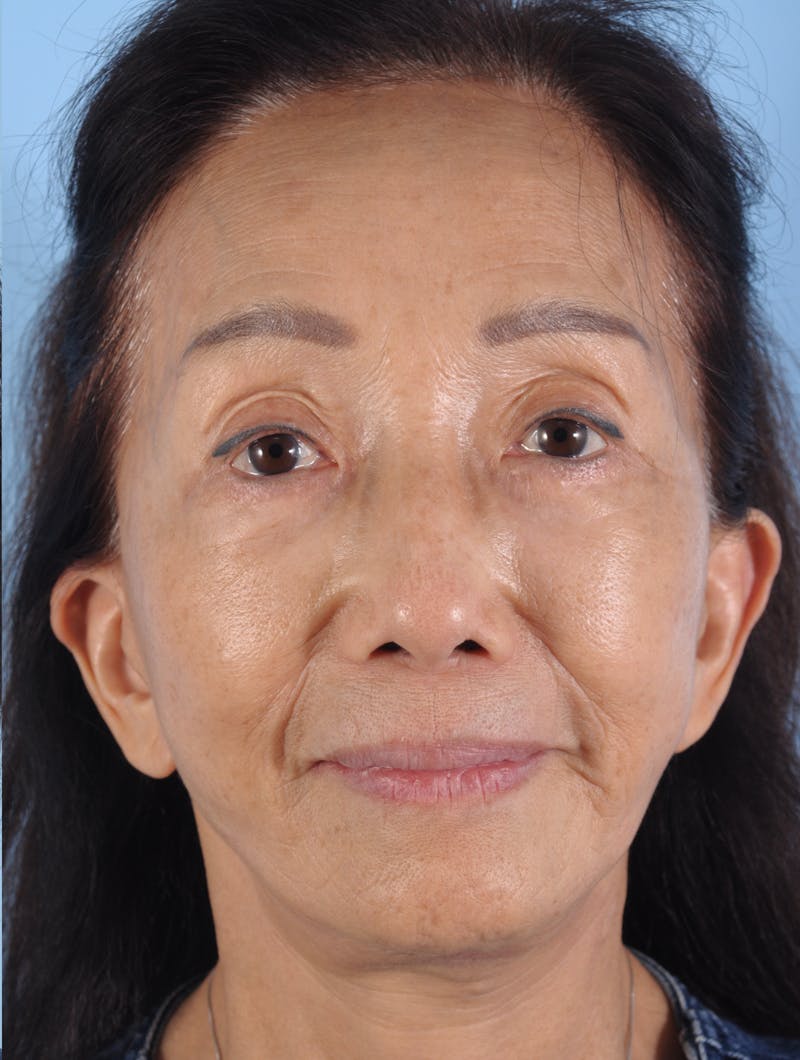 Upper Blepharoplasty Before & After Gallery - Patient 476654 - Image 2