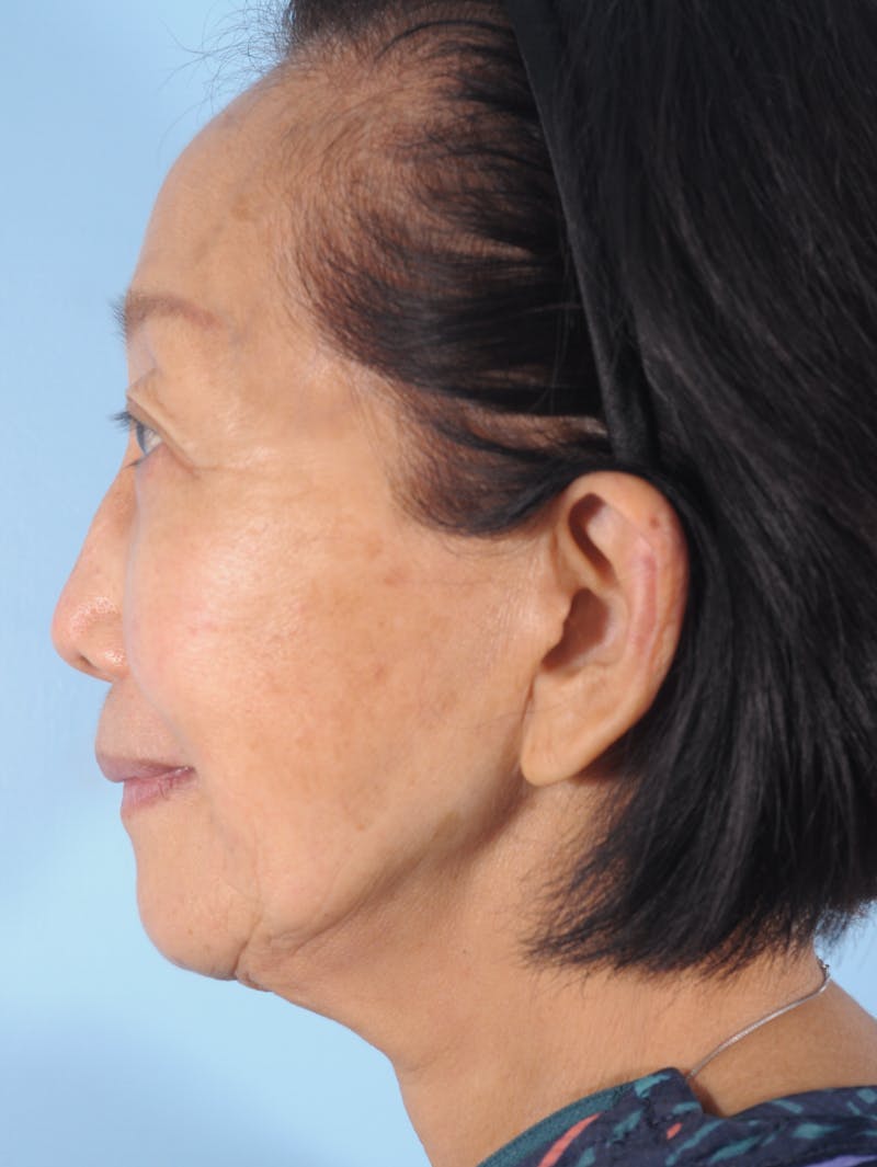 Upper Blepharoplasty Before & After Gallery - Patient 476654 - Image 3