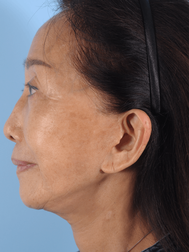 Upper Blepharoplasty Before & After Gallery - Patient 476654 - Image 4