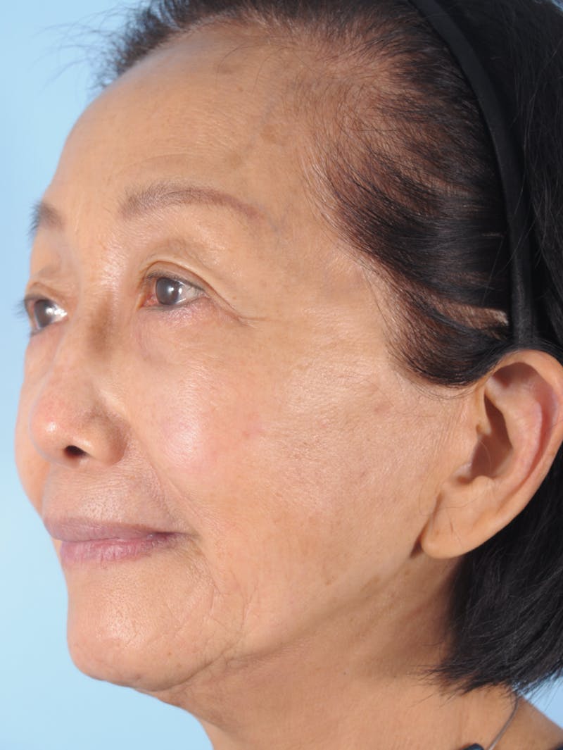 Upper Blepharoplasty Before & After Gallery - Patient 476654 - Image 5