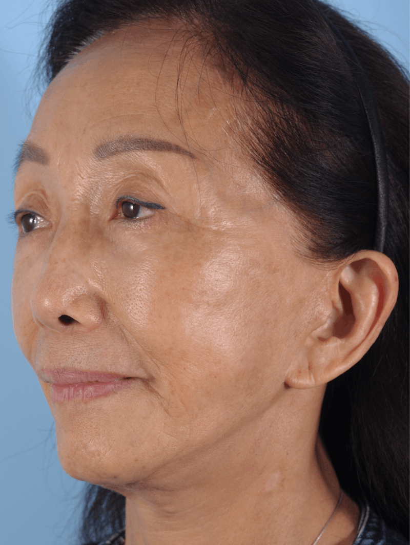 Upper Blepharoplasty Before & After Gallery - Patient 476654 - Image 6