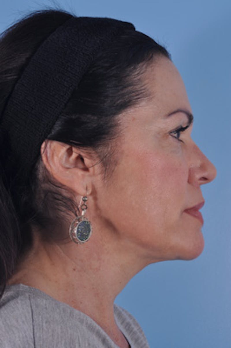 Upper Blepharoplasty Before & After Gallery - Patient 300408 - Image 4