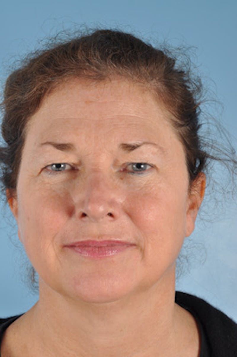 Upper Blepharoplasty Before & After Gallery - Patient 333742 - Image 1