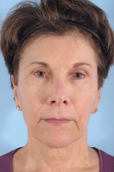 Upper Blepharoplasty Before & After Gallery - Patient 182328 - Image 1