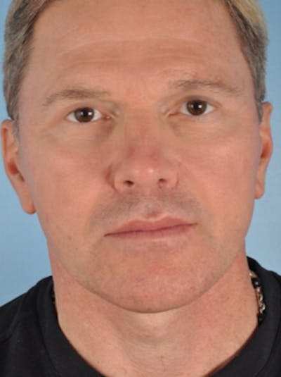 Lower Blepharoplasty Before & After Gallery - Patient 210084 - Image 2