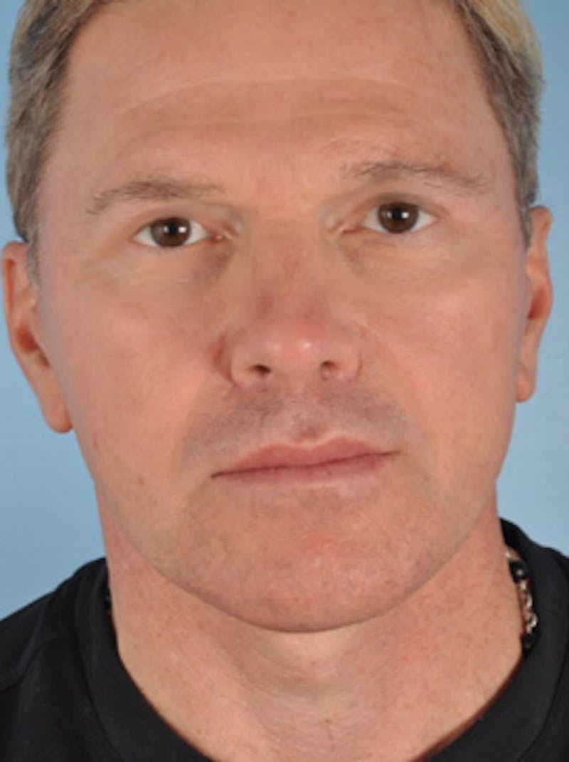 Lip Lift / Implants Before & After Gallery - Patient 124565 - Image 2