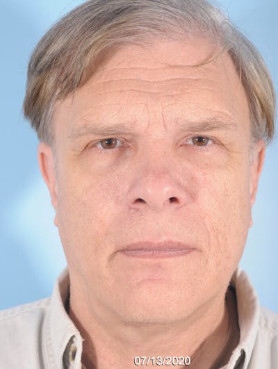 Upper Blepharoplasty Before & After Gallery - Patient 263414 - Image 1