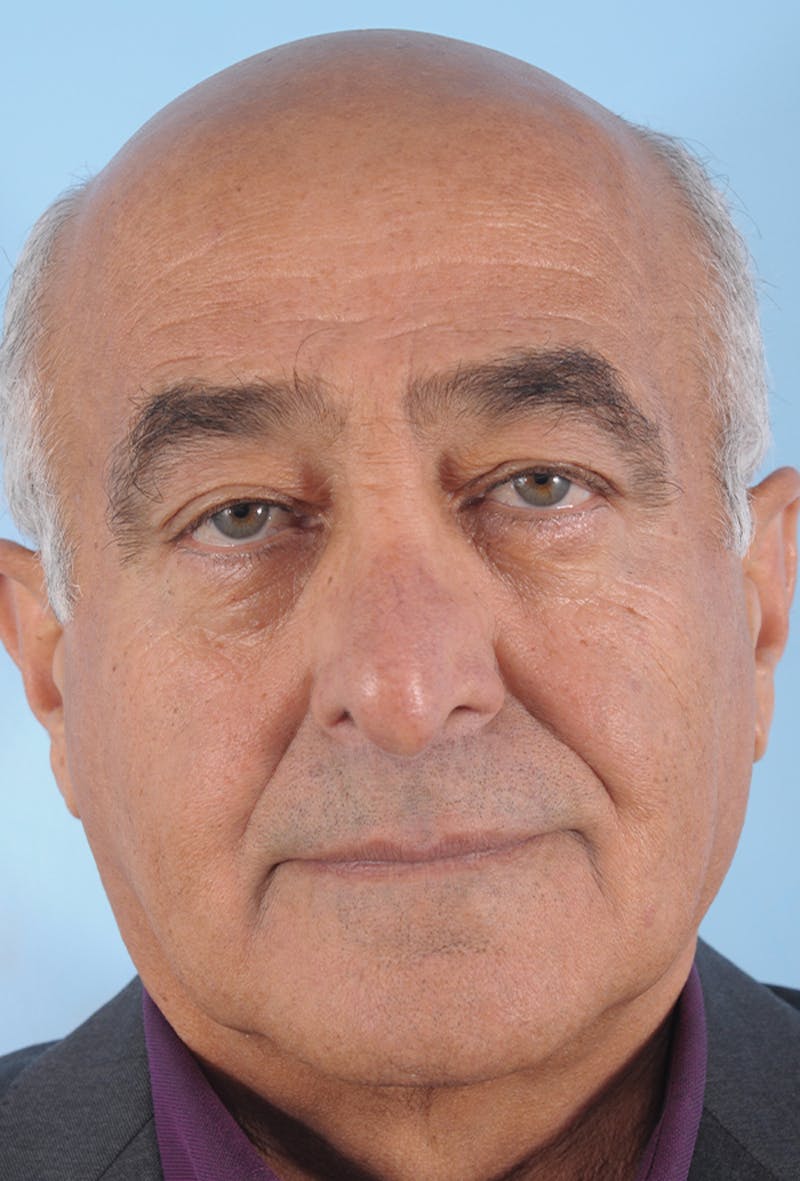 Upper Blepharoplasty Before & After Gallery - Patient 254488 - Image 1