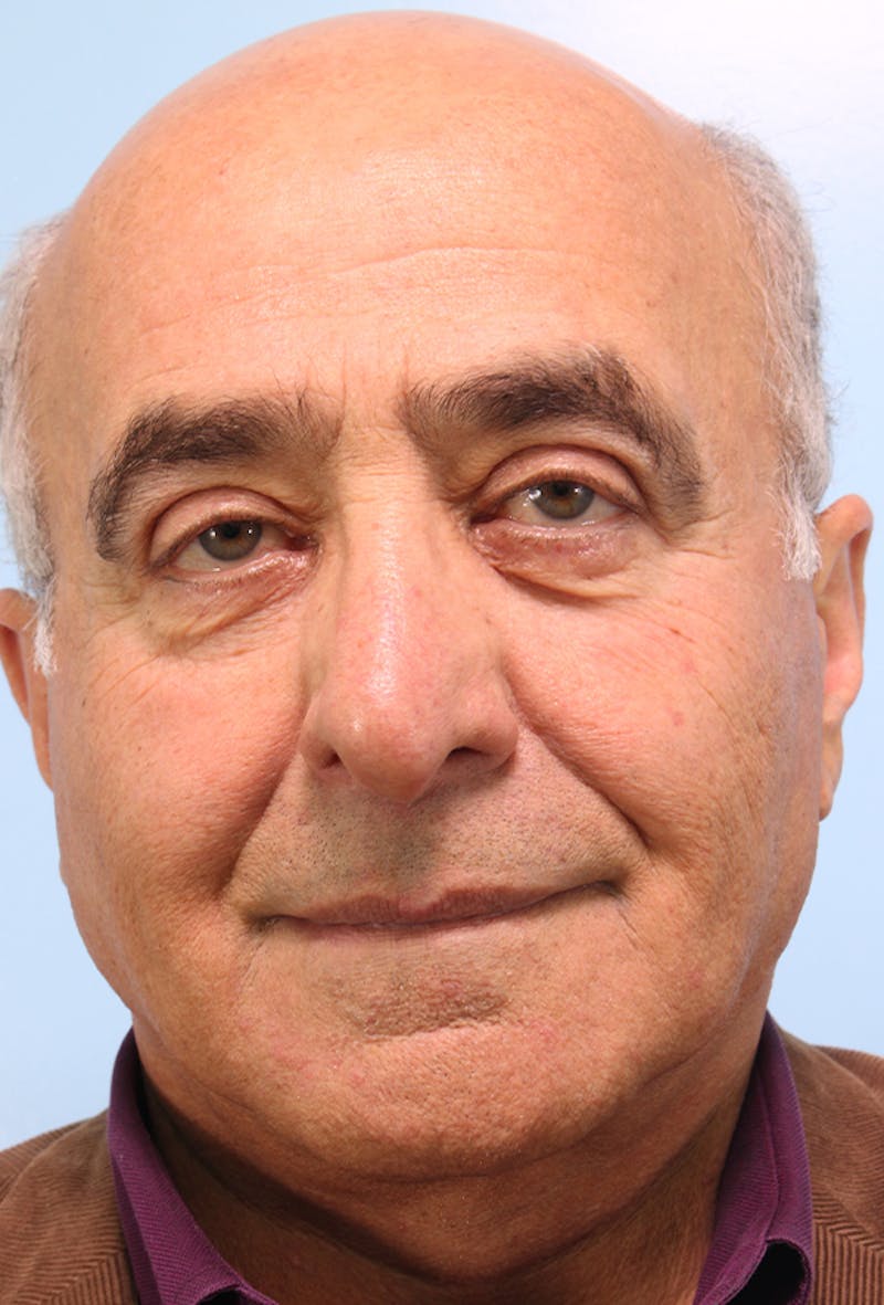 Upper Blepharoplasty Before & After Gallery - Patient 254488 - Image 2