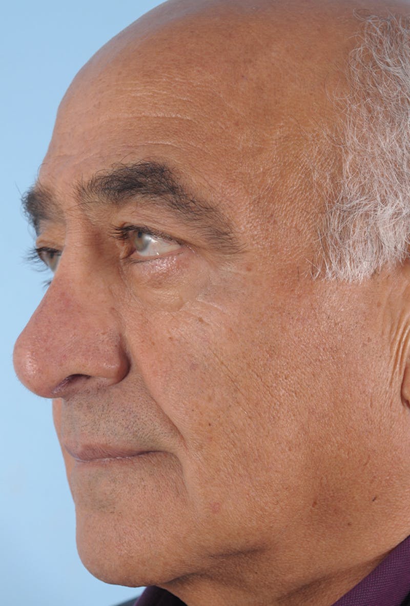 Upper Blepharoplasty Before & After Gallery - Patient 254488 - Image 3