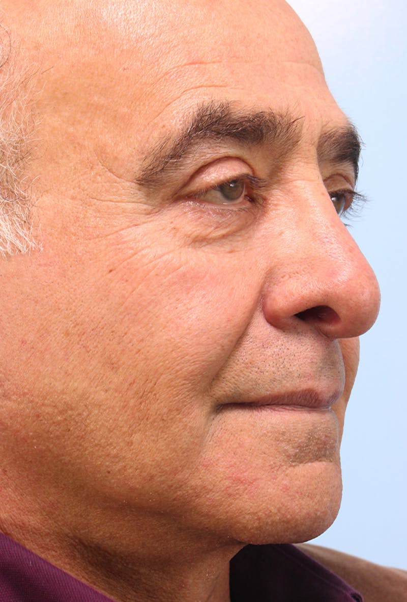 Upper Blepharoplasty Before & After Gallery - Patient 254488 - Image 6