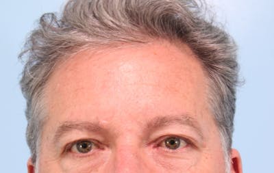 Upper Blepharoplasty Before & After Gallery - Patient 230049 - Image 1