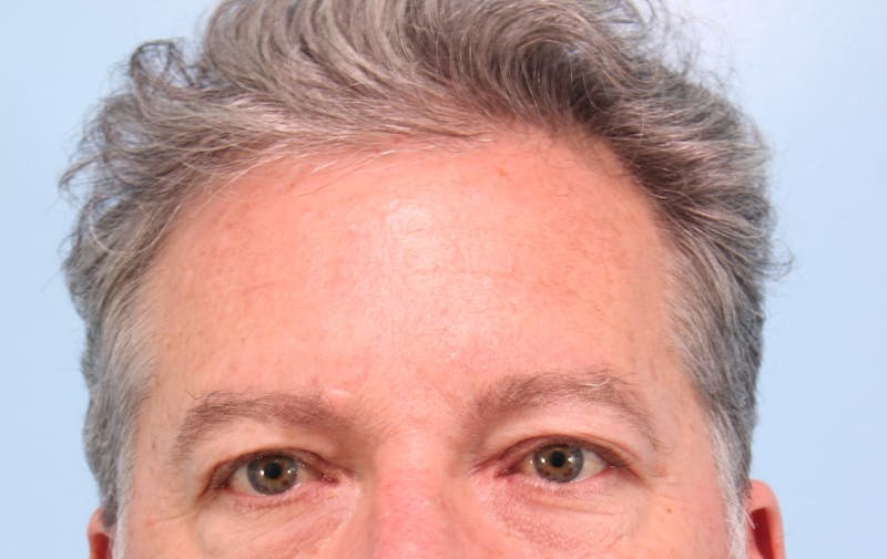 Upper Blepharoplasty Before & After Gallery - Patient 230049 - Image 1