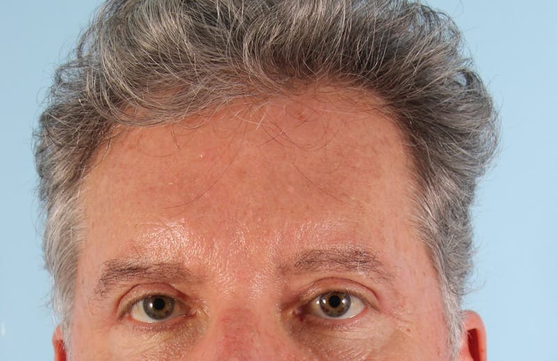 Upper Blepharoplasty Before & After Gallery - Patient 230049 - Image 2