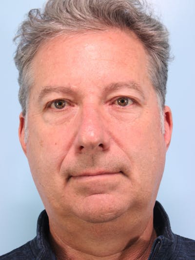 Lower Blepharoplasty Before & After Gallery - Patient 189988 - Image 1