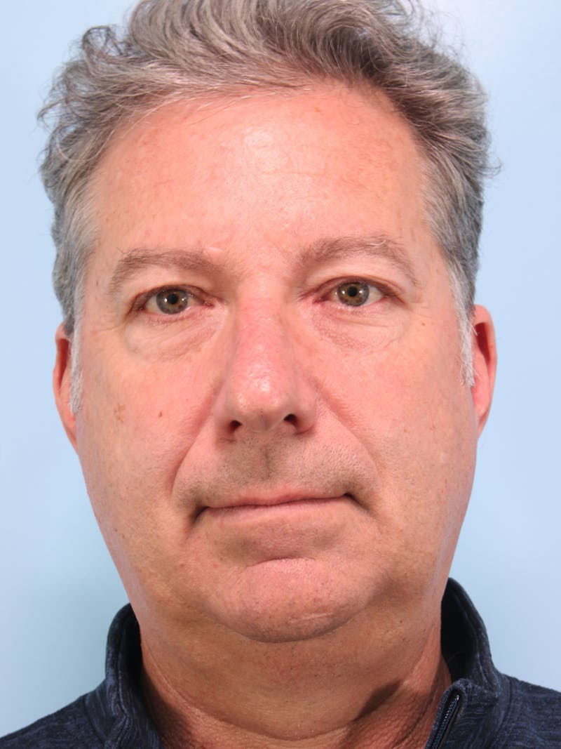 Lower Blepharoplasty Before & After Gallery - Patient 189988 - Image 1