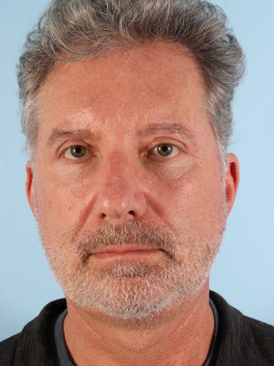 Lower Blepharoplasty Before & After Gallery - Patient 189988 - Image 2